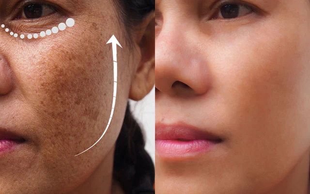 Qu'est-ce que l'acide kojique et comment éclaircit-il la peau ?