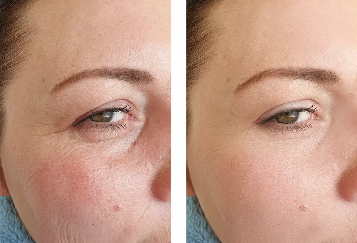 Retinol