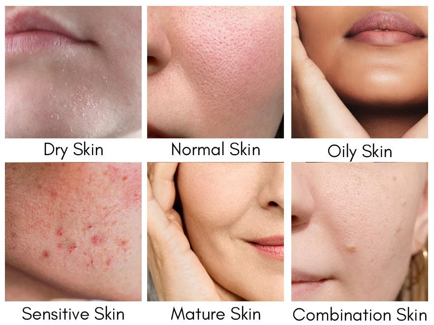 Skin types ideal for Azelaic and Salicylic Acid use