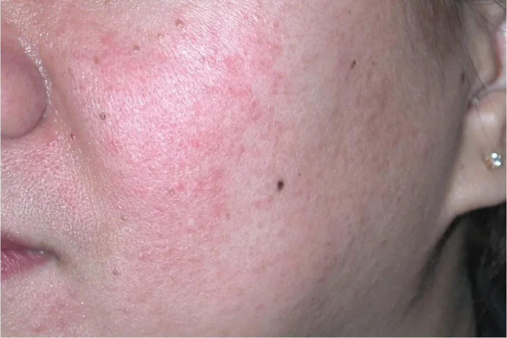 rosacea mild 1068x712 1