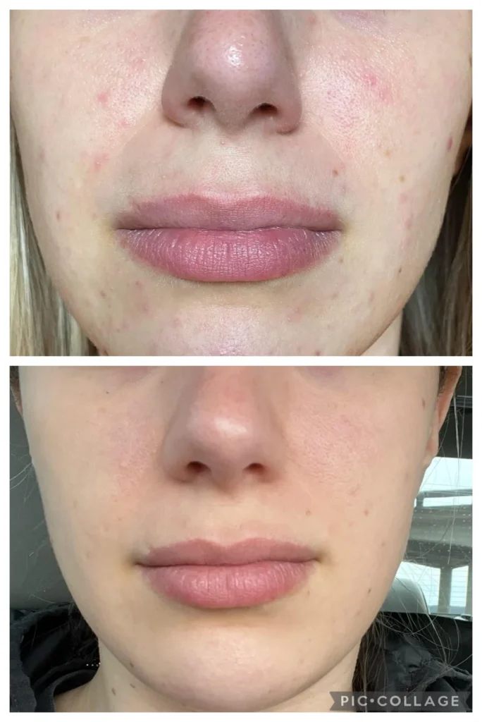 using azelaic acid twice a day has made the biggest v0 hgg6qrwda8j81
