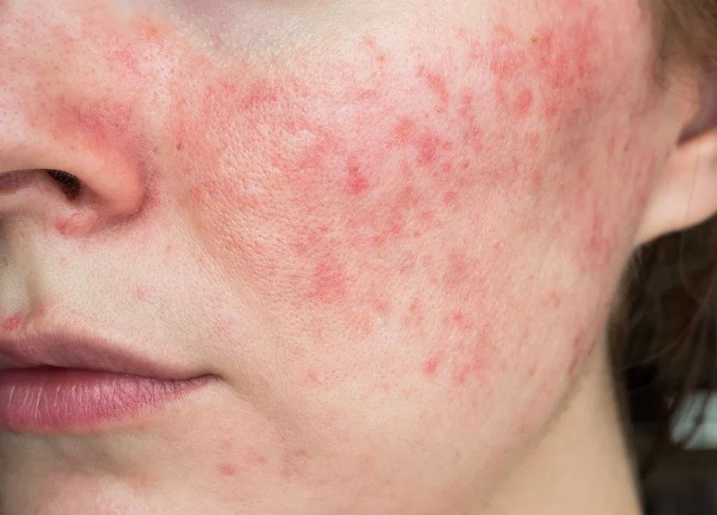 sensitive reactive skin