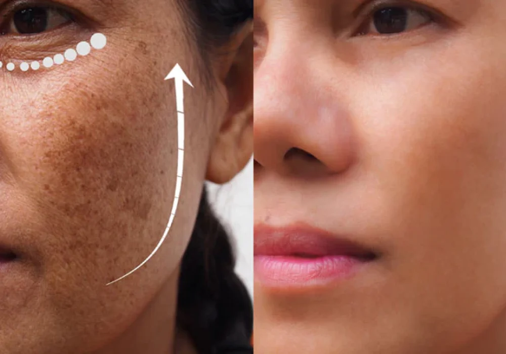 image-before-and-after-anti-aging-dark-spot_1024x400
